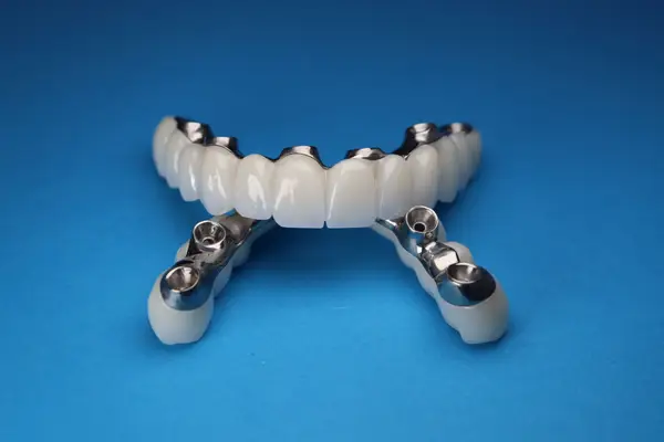 A fixed full-arch implant bridge on a blue background