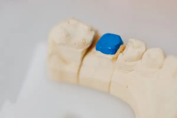 Dental model of a back tooth with a blue inlay restoration